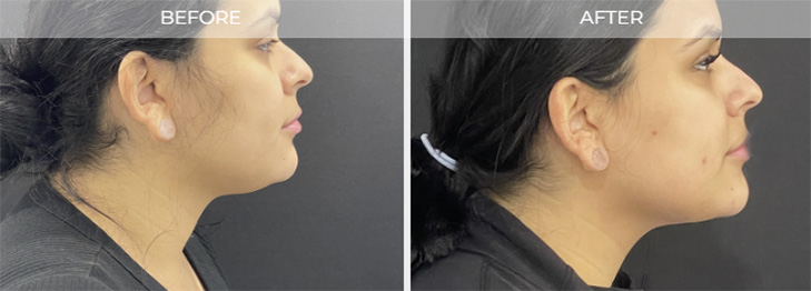 Chin Liposuction NJ 