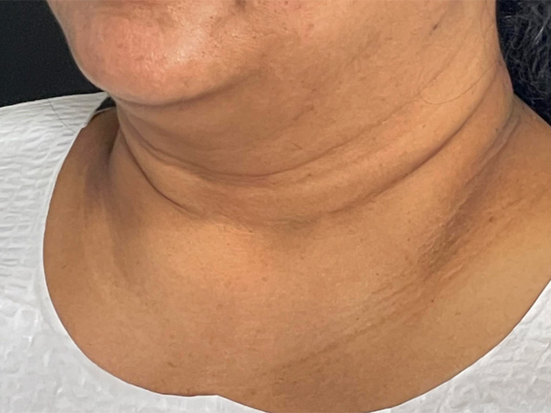Chin Liposuction Photos Before