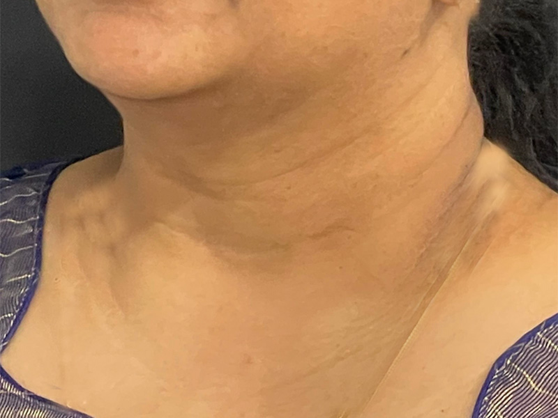 Chin Liposuction Photos Front After