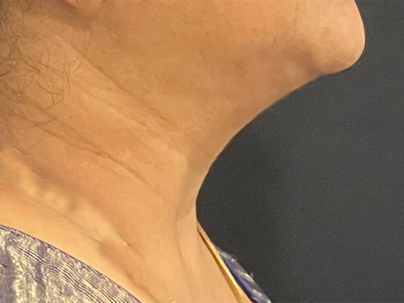 Chin Liposuction Photos Right After