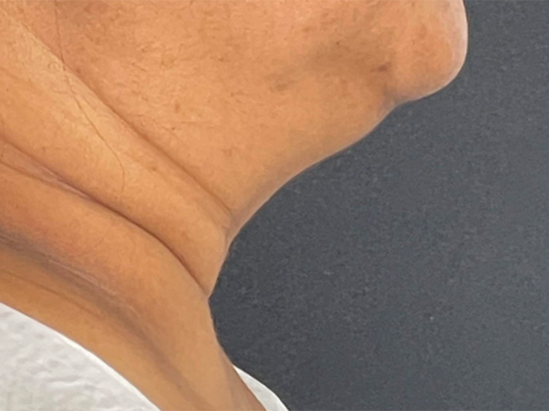 Chin Liposuction Photos Right Before
