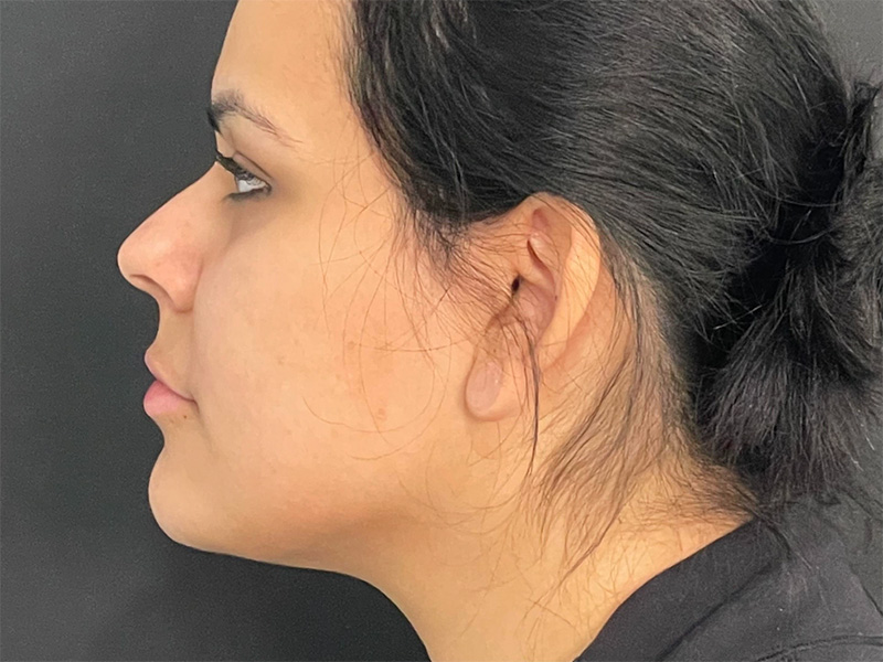 Chin Liposuction Left After