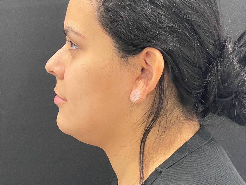 Chin Liposuction Left Before