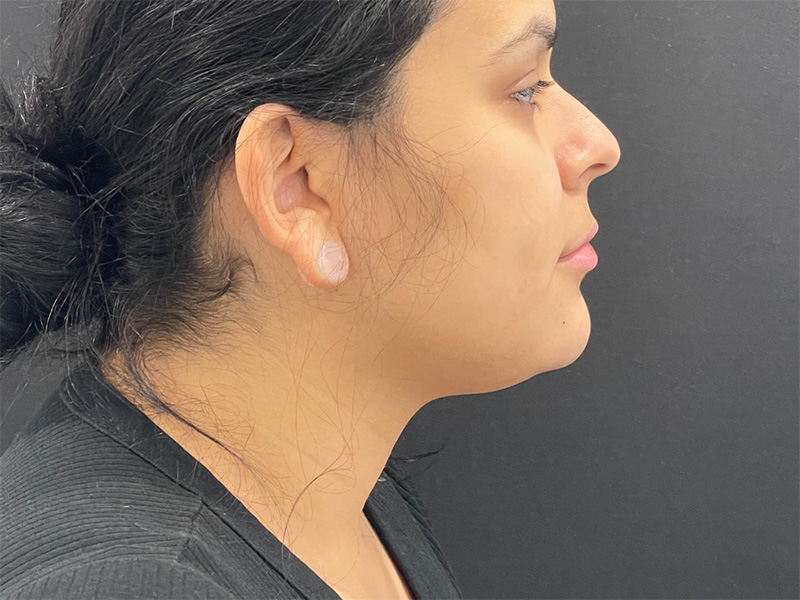 Chin Liposuction Right Before