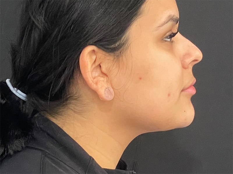 Chin Liposuction Right After