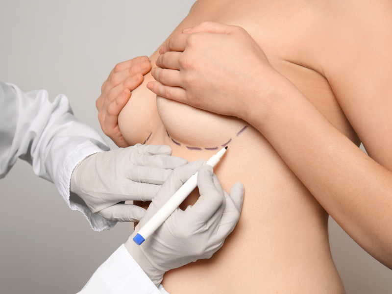 Common Questions About Breast Revision Surgery