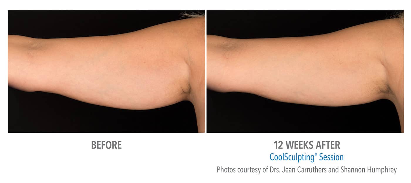Coolsculpting New Jersey Arms