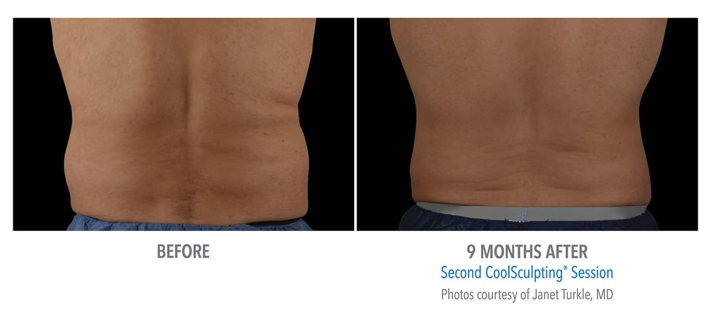 Coolsculpting Procedure Love Handles Coolsculpting Cost