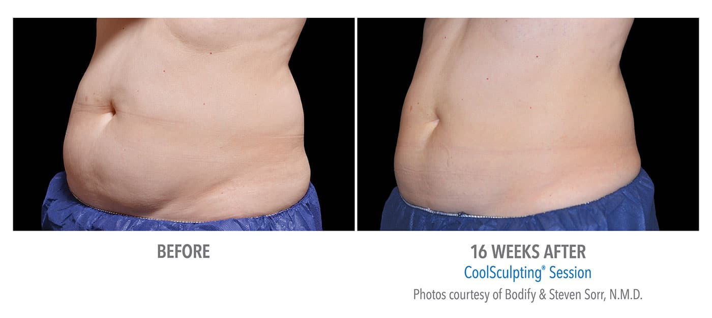 Coolsculpting New Jersey abdomen