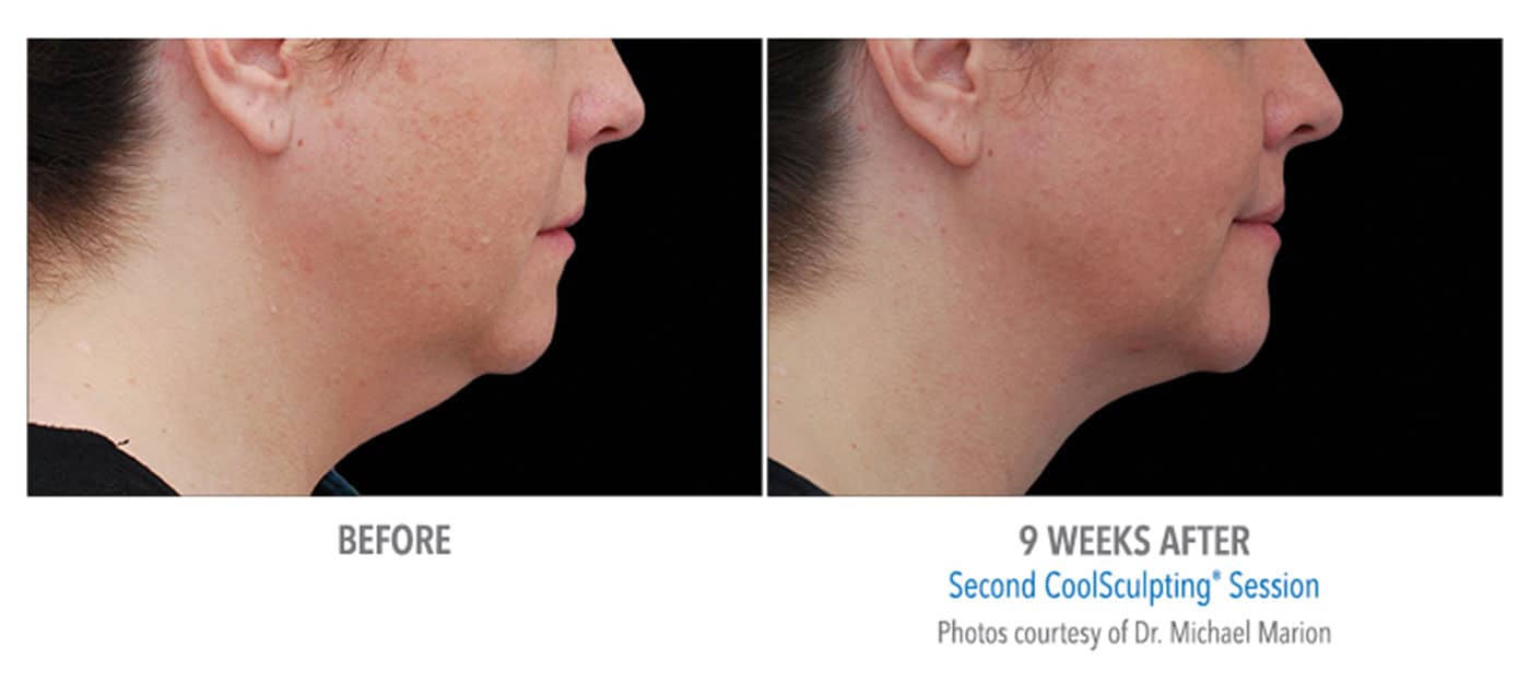 Coolsculpting New Jersey face