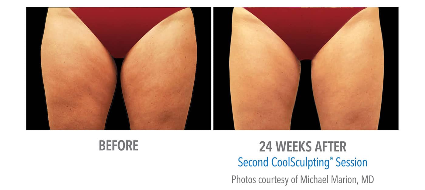 Coolsculpting New Jersey thighs
