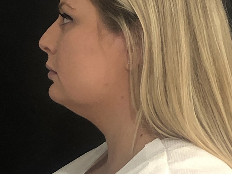 Coolsculpting New Jersey Lateral After