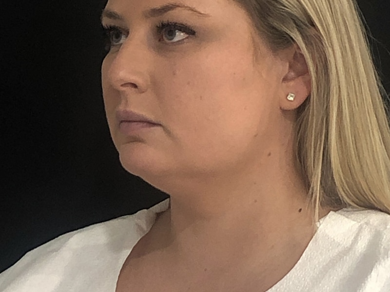 Coolsculpting New Jersey Oblique After