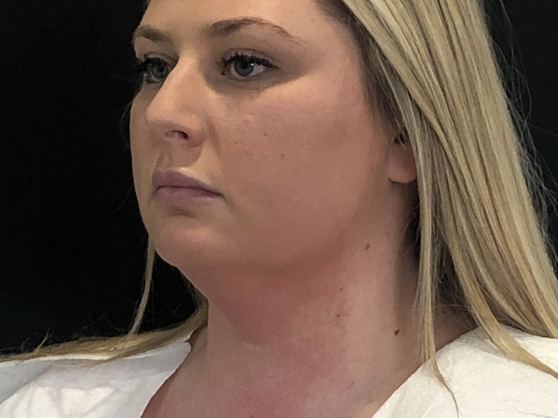 Coolsculpting New Jersey Oblique Before