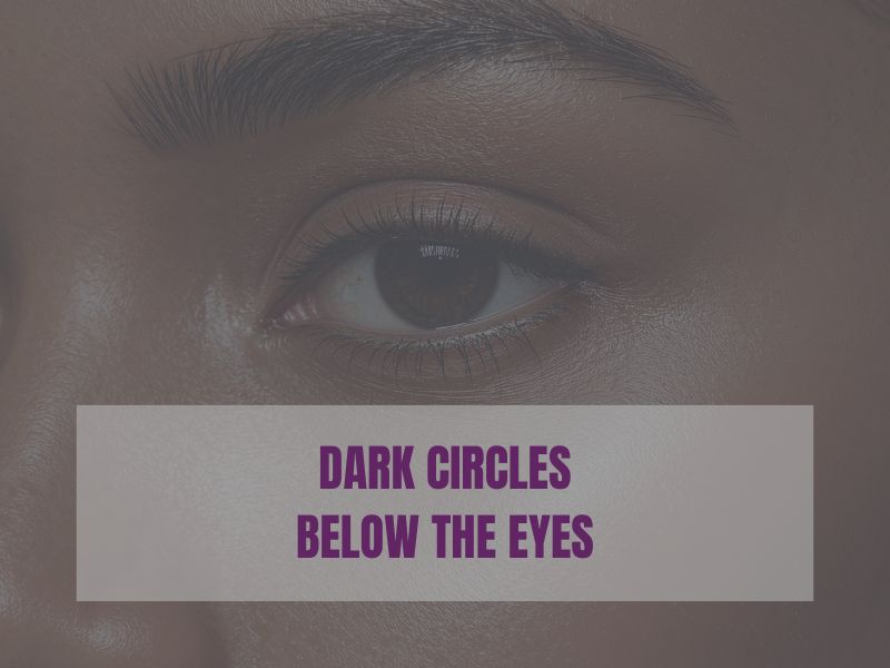 Dark Circles Below The Eyes