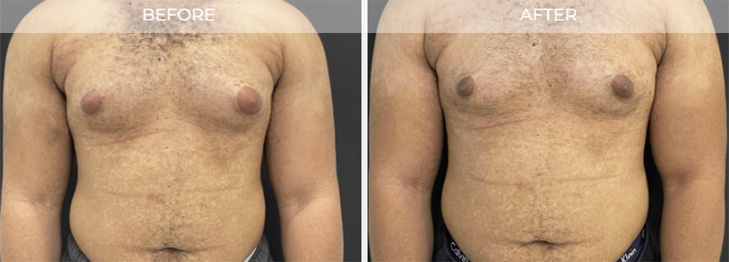 Gynecomastia New Jersey