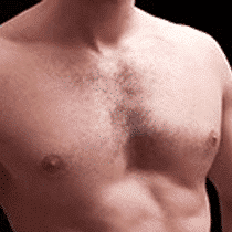 Gynecomastia Procedure