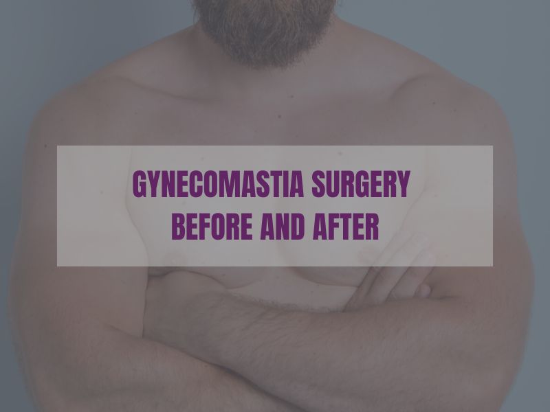 Gynecomastia Surgery Before and After