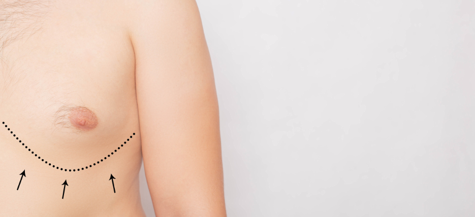 How To Get Gynecomastia Surgery Covered By Insurance