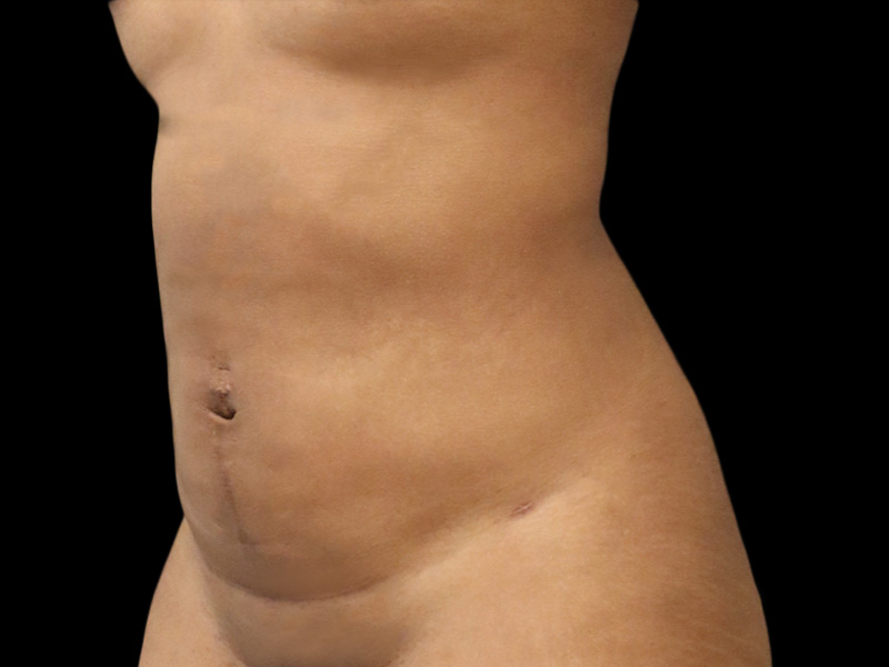 JC after oblique