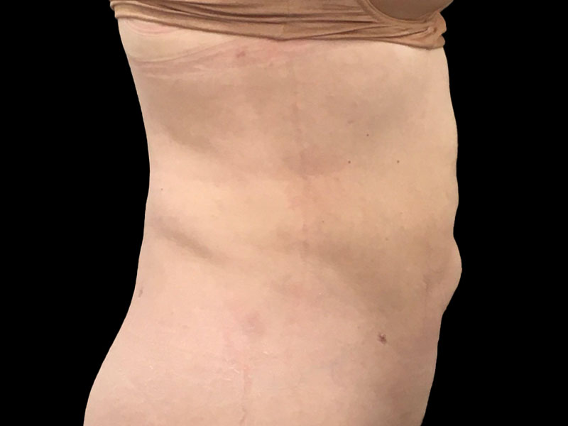 New Jersey Liposuction Anterior After