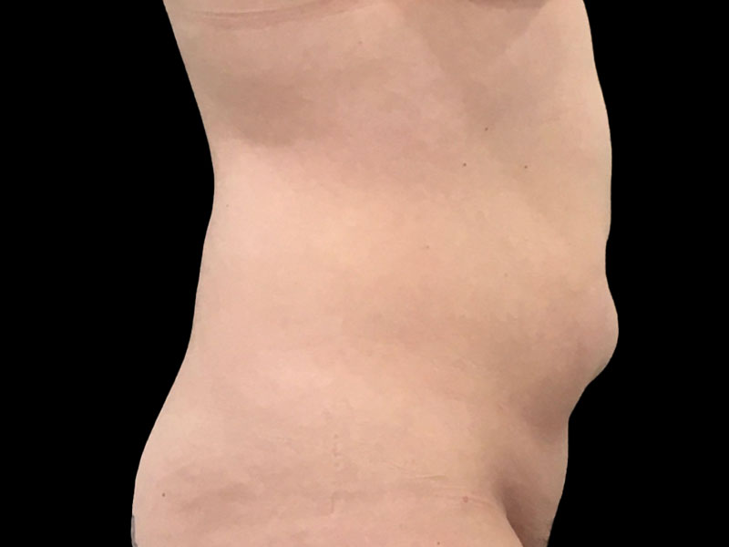 New Jersey Liposuction Anterior Before