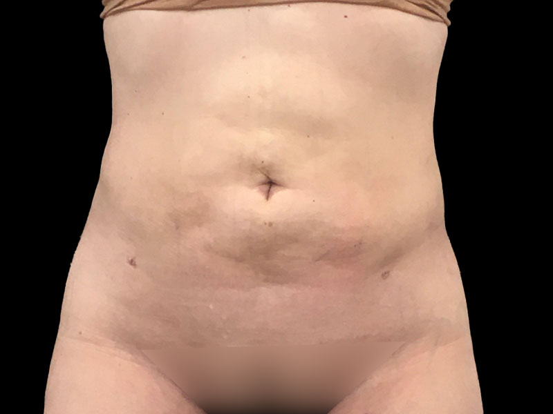 New Jersey Liposuction Anterior After