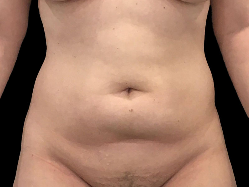 New Jersey Liposuction Anterior Before