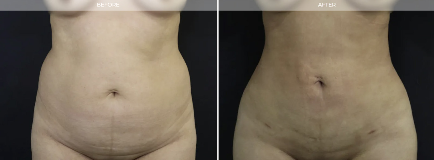 Liposuction New Jersey
