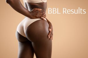 Lost all fat after BBL Lost all fat after BBL