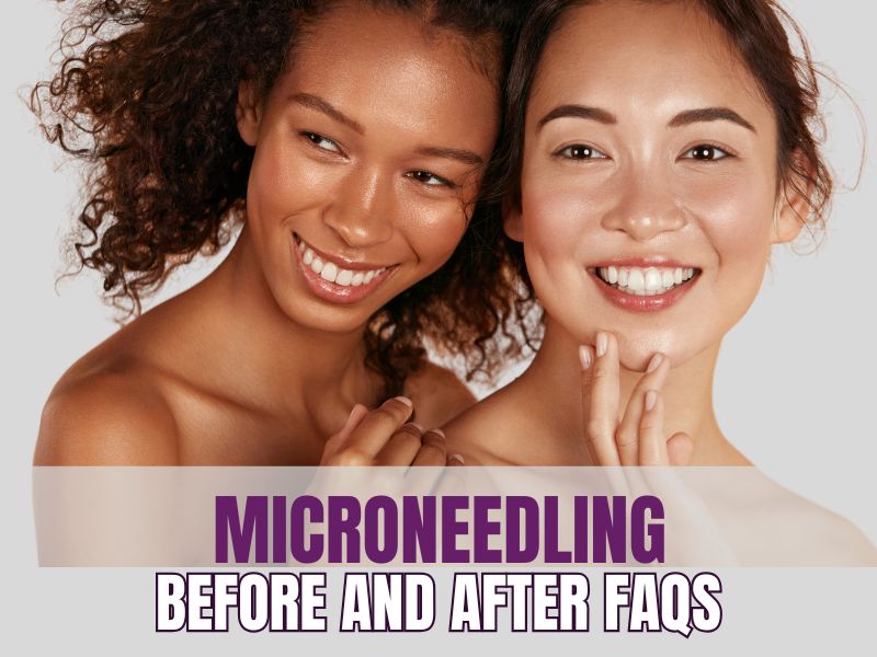 Microneedling Results Before and After