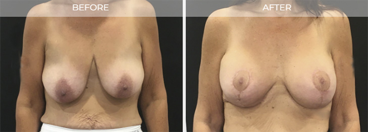 NJ Breast Lift