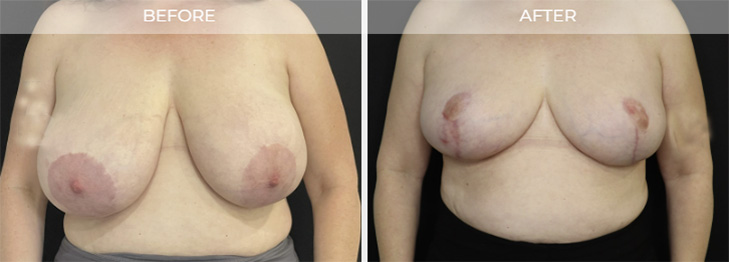 NJ Breast Reduction