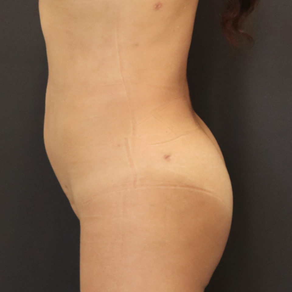 New Jersey Brazilian Butt Lift Back After