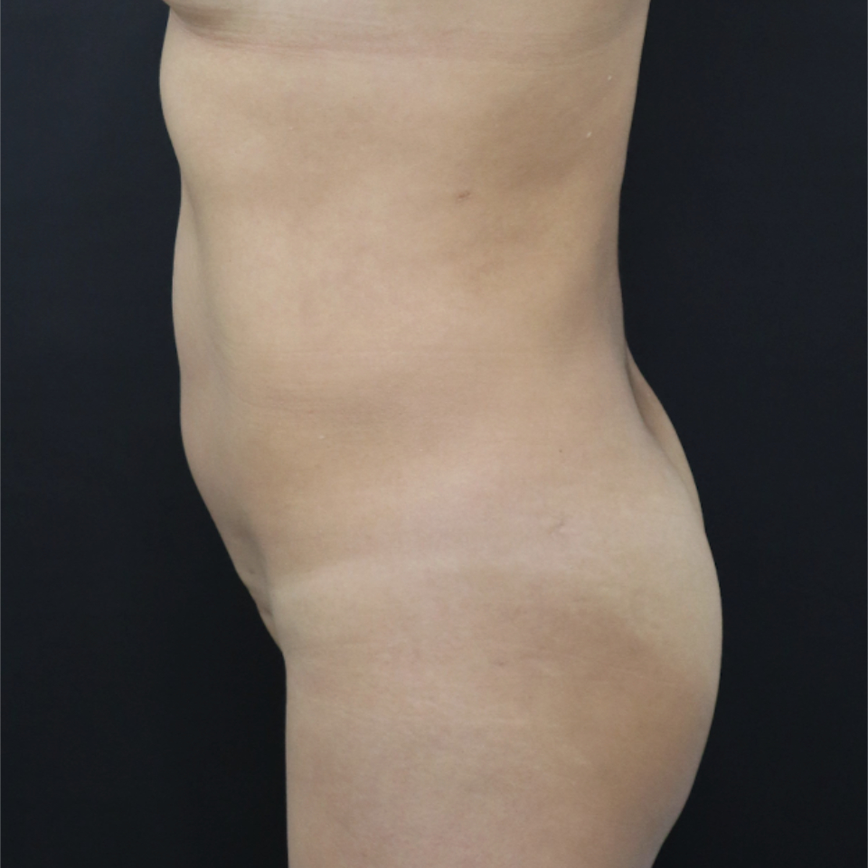 New Jersey Brazilian Butt Lift Back Before