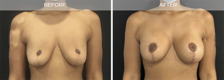 New Jersery Breat Lift