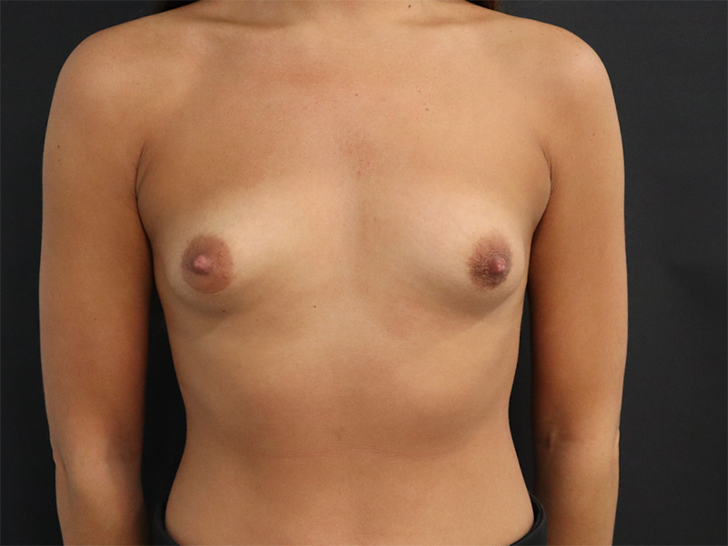 New Jersey Breast Augmentation Patient 10 Front Before