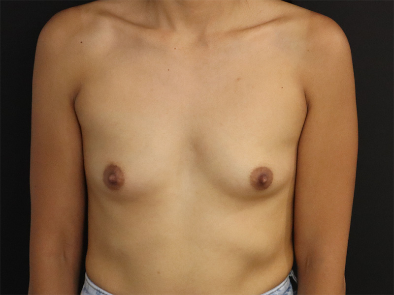 New Jersey Breast Augmentation Patient 11 Front Before