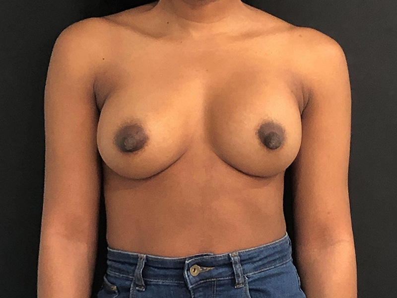 New Jersey Breast Augmentation Front After