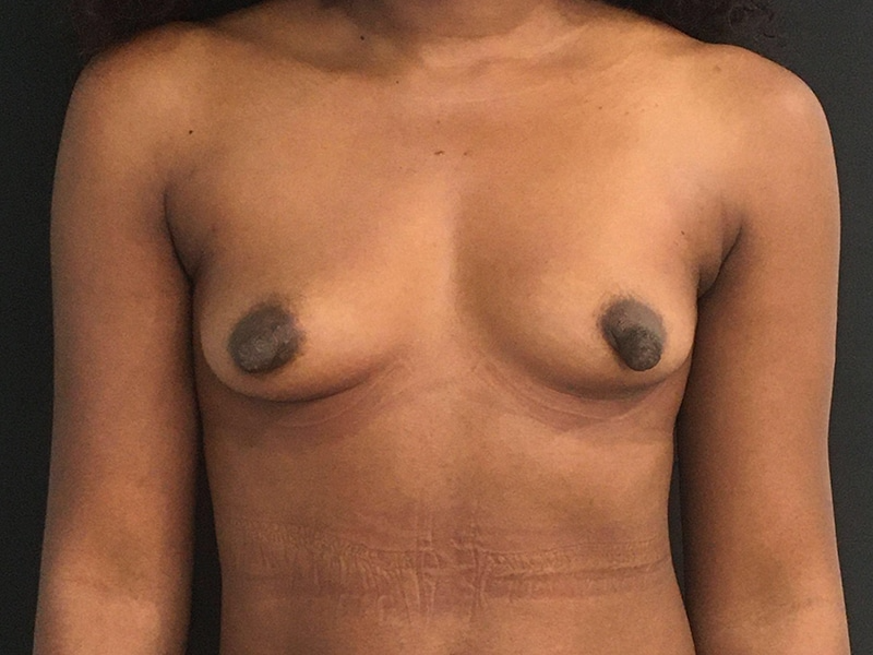 New Jersey Breast Augmentation Front Before