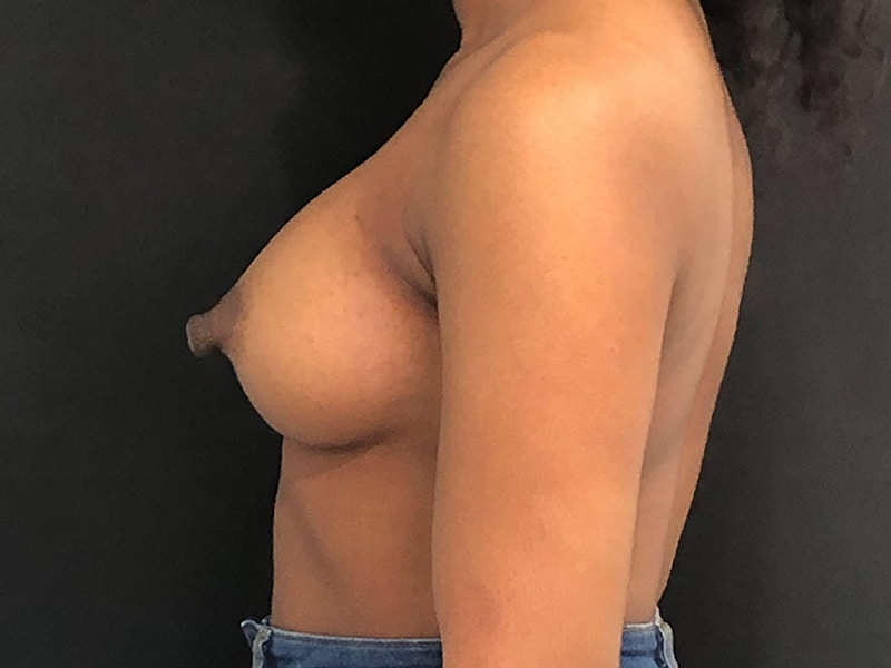 New Jersey Breast Augmentation Lateral After