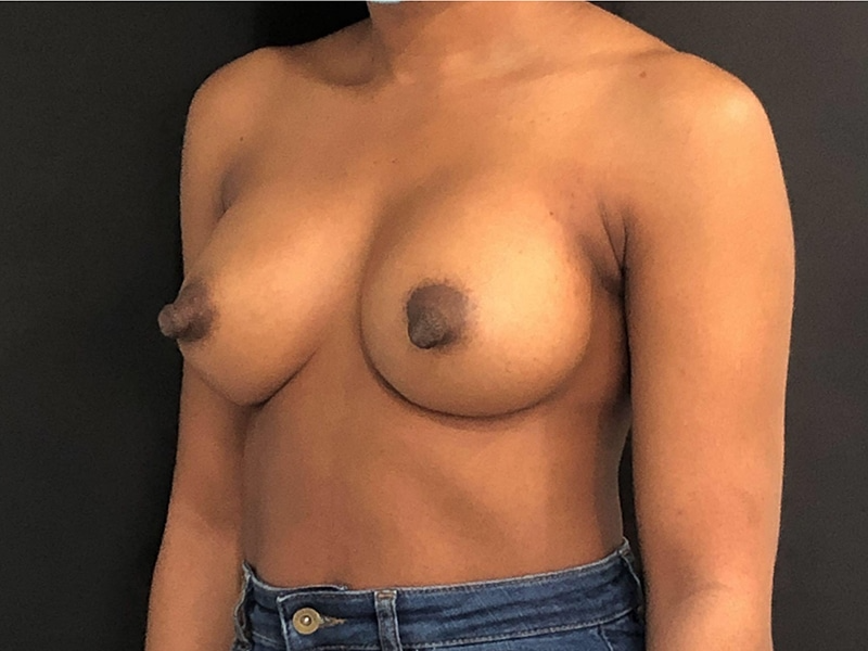 New Jersey Breast Augmentation Oblique After
