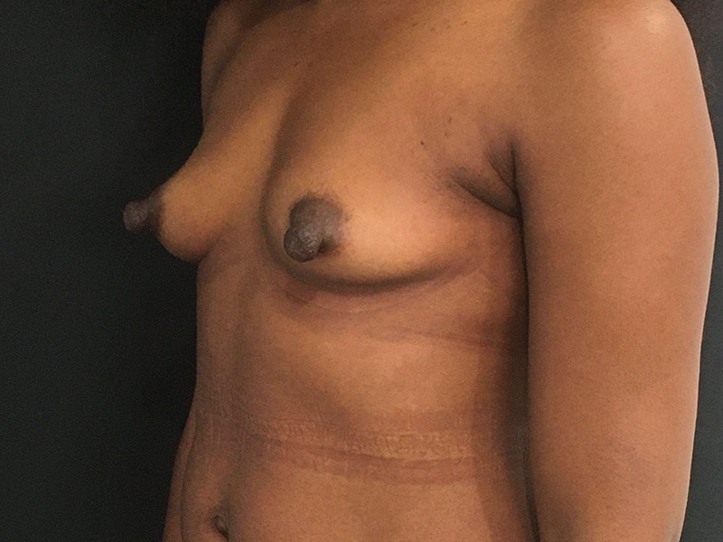 New Jersey Breast Augmentation Oblique Before
