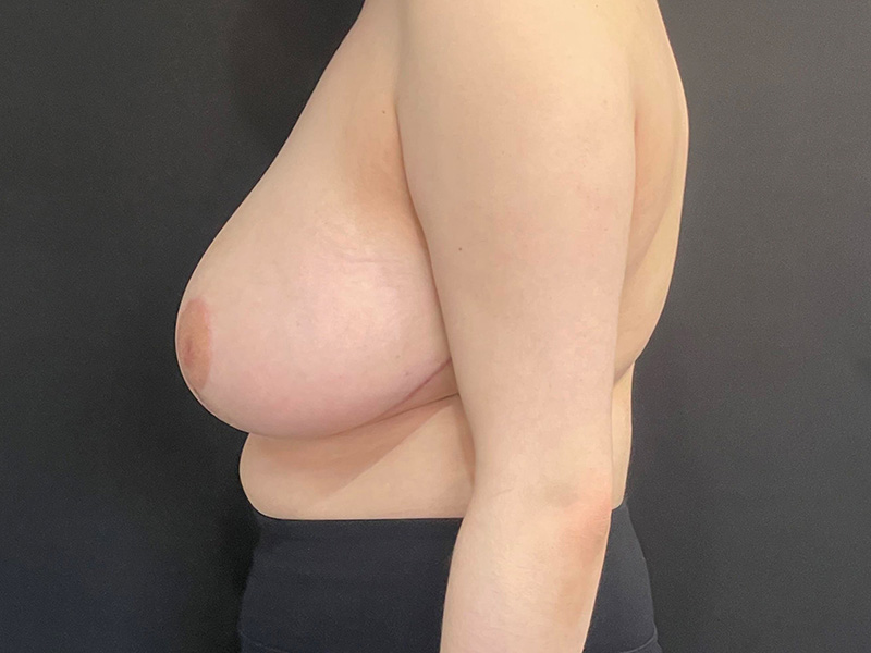 New Jersey Breast Reduction After Lateral