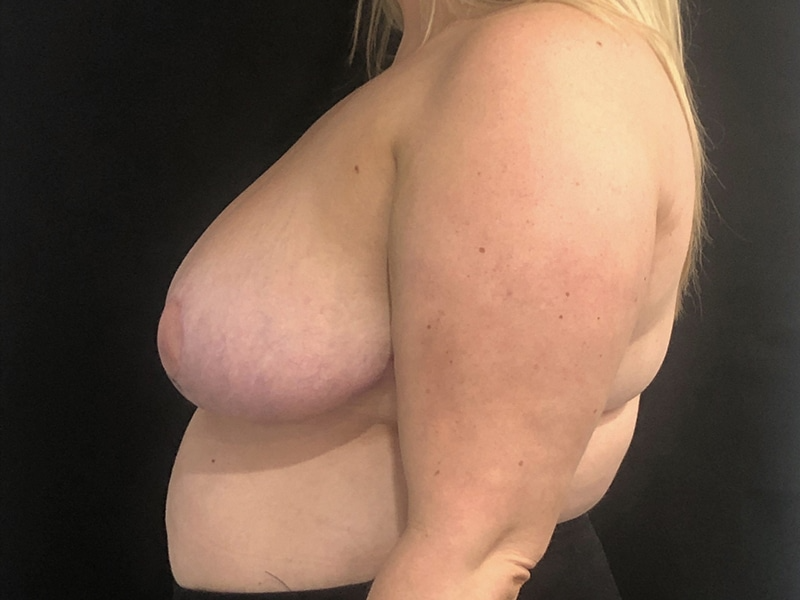 New Jersey Breast Reduction Lateral After
