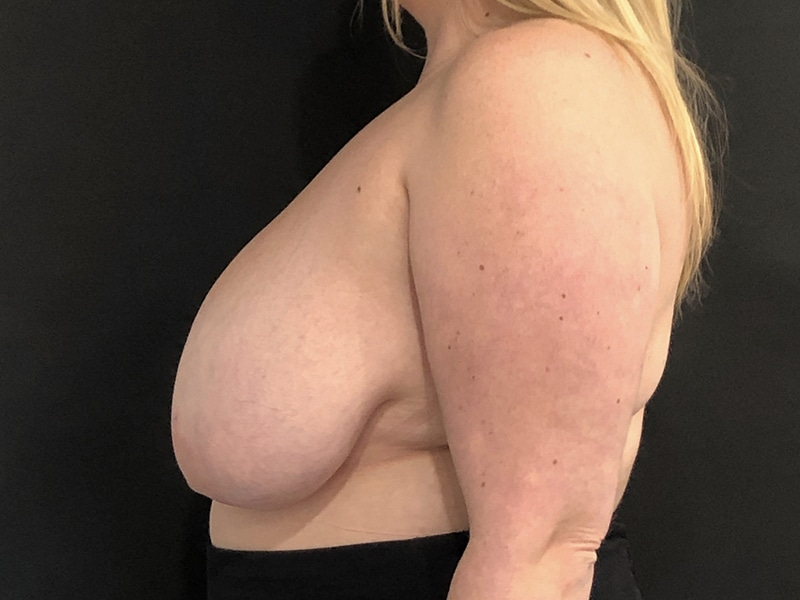 New Jersey Breast Reduction Lateral Before