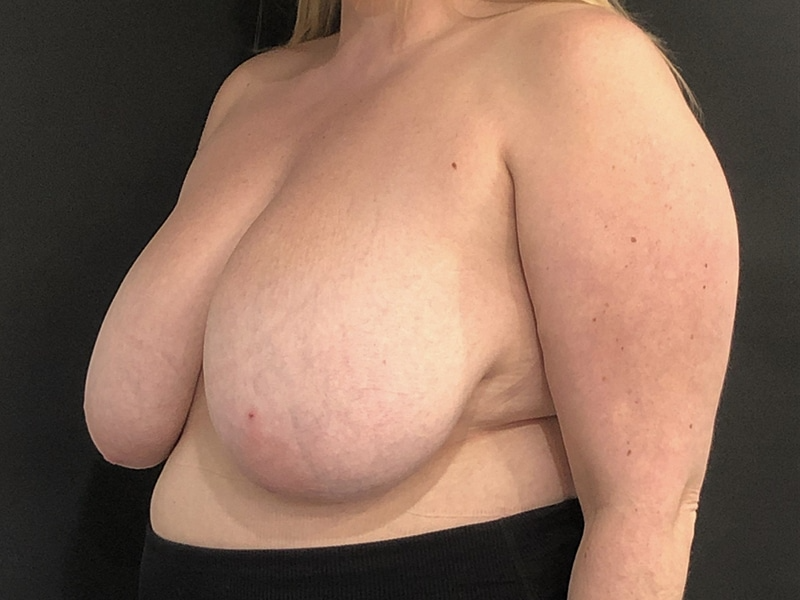 New Jersey Breast Reduction Oblique Before