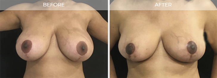New Jersey Breast Reduction