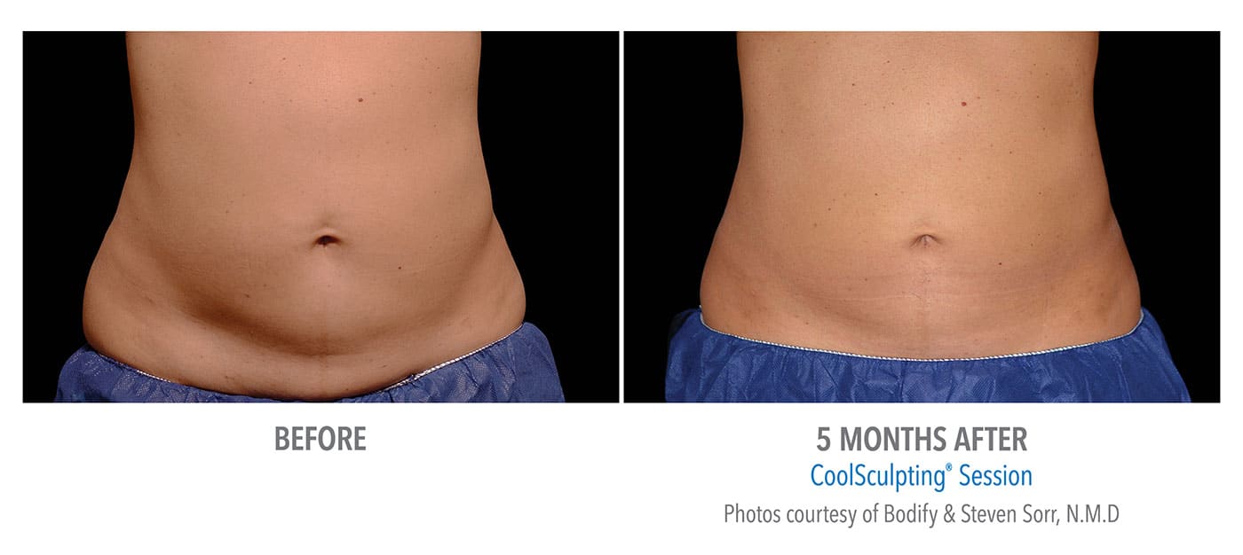 New Jersey Coolsculpting abdomen
