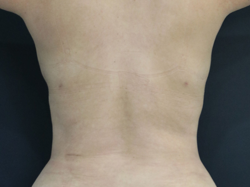 New Jersey Liposuction Before After Back